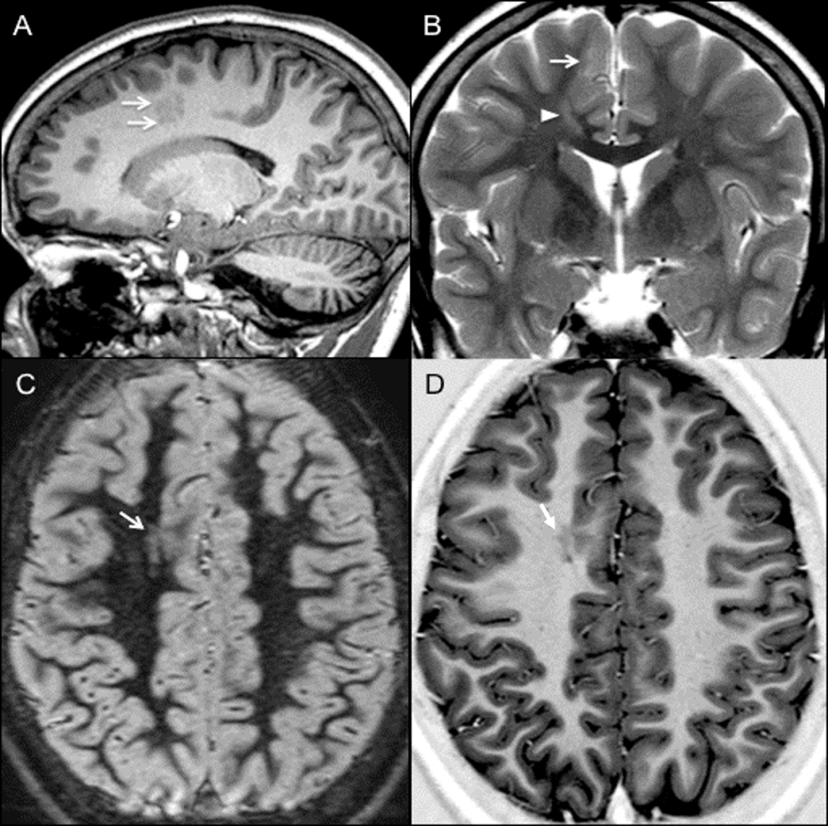 Epilepsia sindrome de lennox gastaut